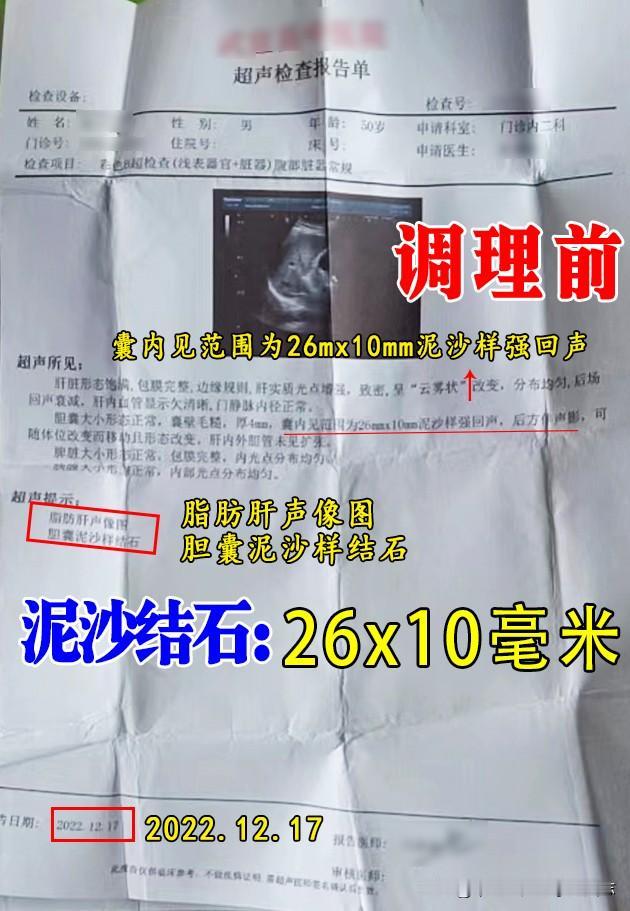 陆先生，泥沙样结石26*10mm，够大了吧，而且伴有胆囊毛糙、壁厚4mm，还有胆