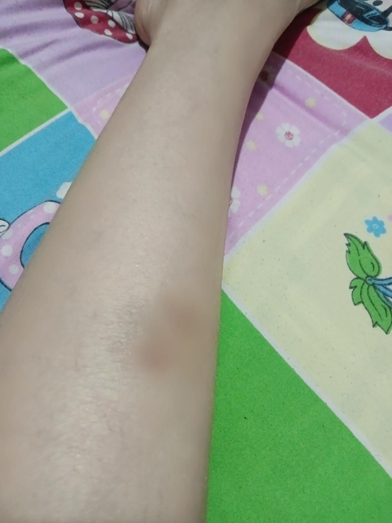 今天晚上洗腿才看见，腿肚子上面不知道啥时候碰的都变色了。我说这两天咋这么疼？干活