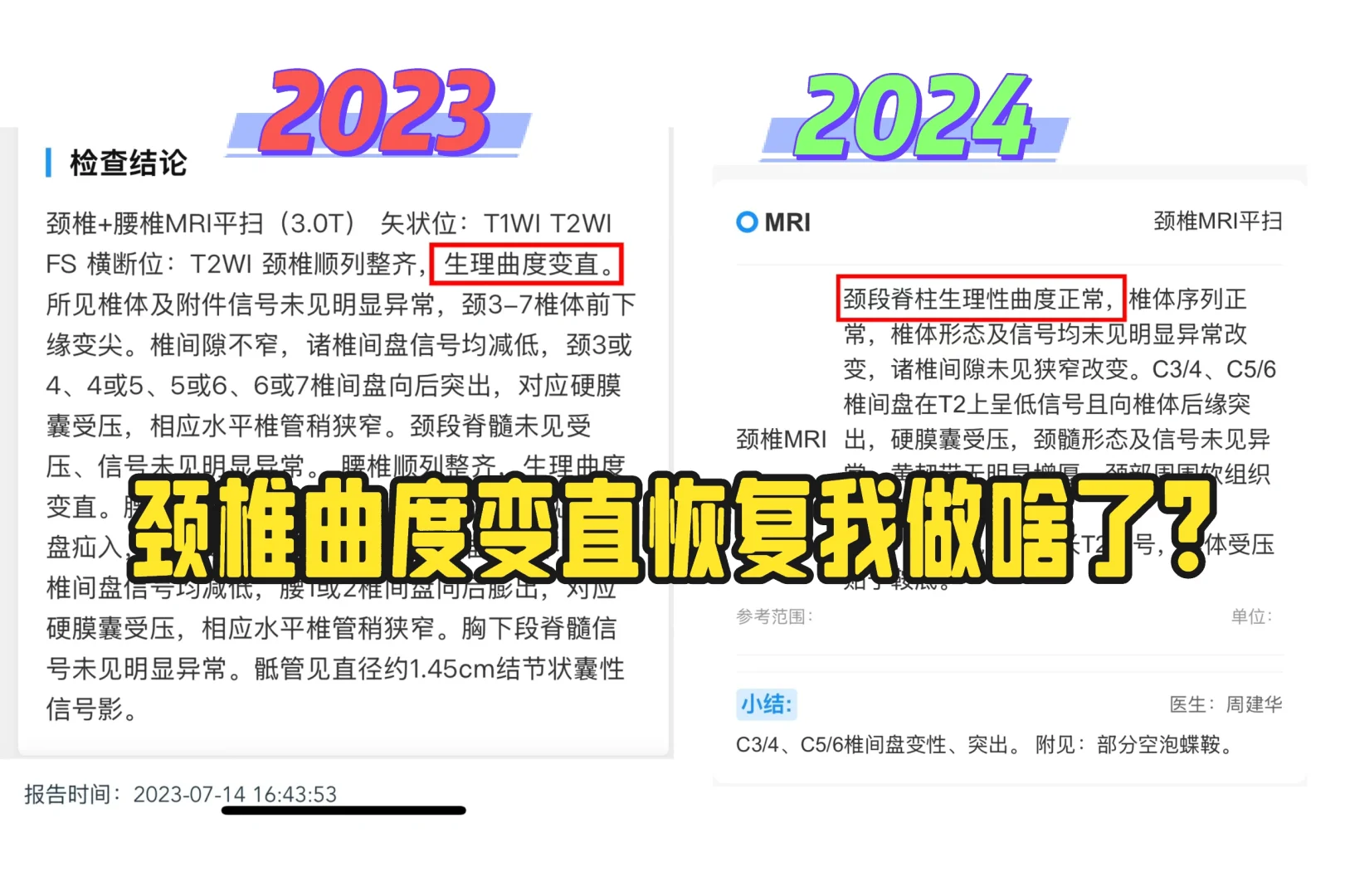 颈椎曲度变直恢复我做了啥？