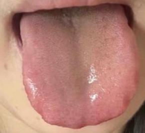 舌头变成这个样子了，怪不得一米七几的个子，都瘦成竹竿了！

我们来看患者的主要情