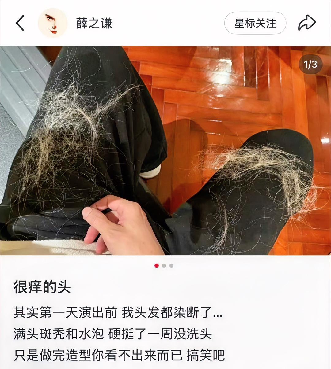 薛之谦满头斑秃和水泡。
原来钱不是那么容易赚的，歌手开演唱会也很辛苦，也很不容易