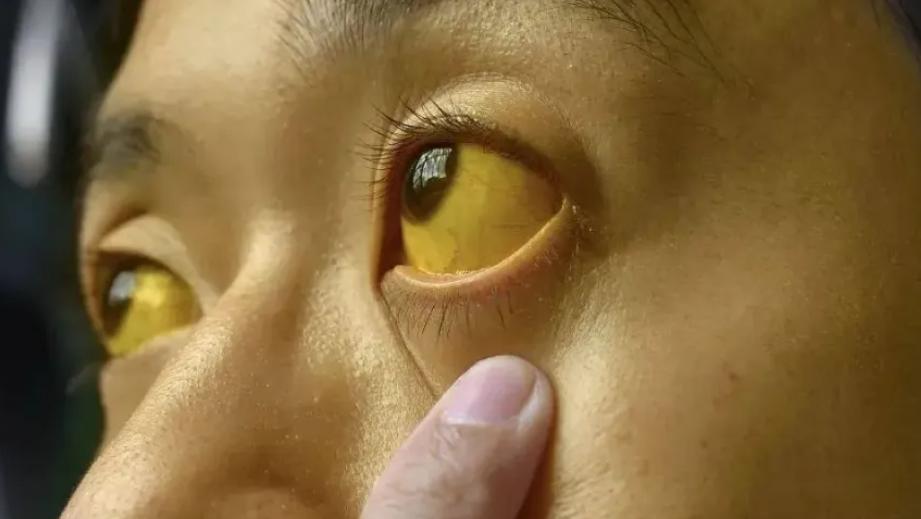 寿命短的肝硬化患者，化验结果常见这4个坏数值，希望你一个没有

说起肝硬化，很多
