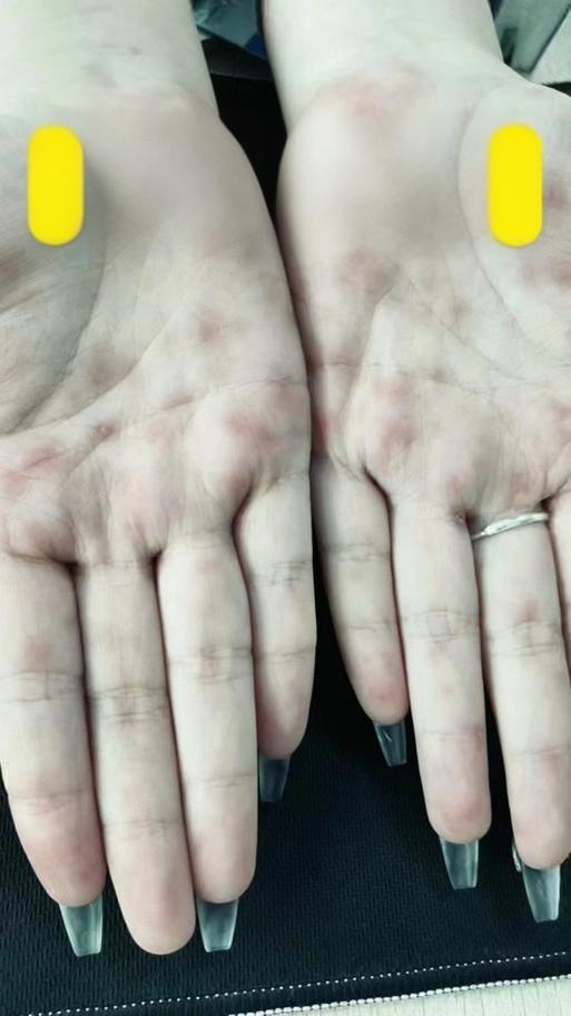 瞒不住了！日本梅毒疯狂扩散，年轻人成了重灾区！

翻开日本厚生劳动省2026年初