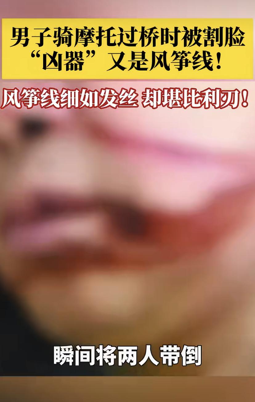 南充一摩托车夫妻路上遭"暗算"，被风筝线割倒在地，伤口触目惊心!
近日，四川南充
