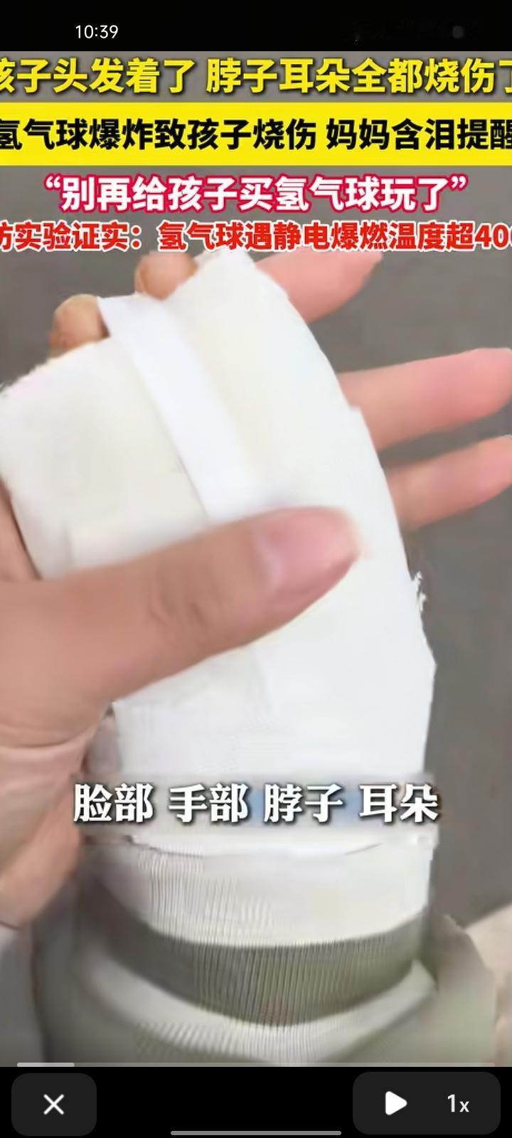 12月6日，河南平顶山。孩子妈妈发视频称，孩子因氢气球爆炸致头发被烧着，脸、手、