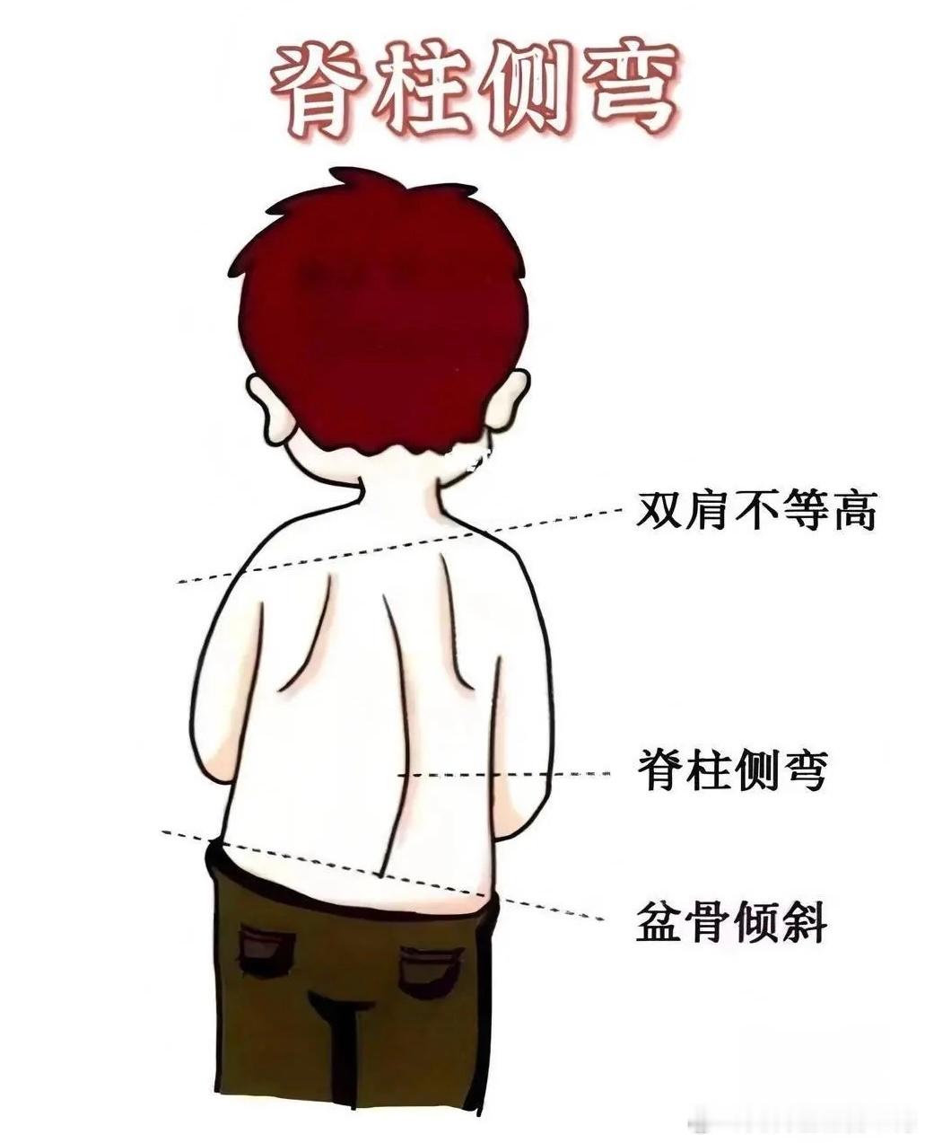 提醒各位家长：比起身高，孩子的脊柱发育更不容忽视！暑假在家时间长，很多孩子习惯性