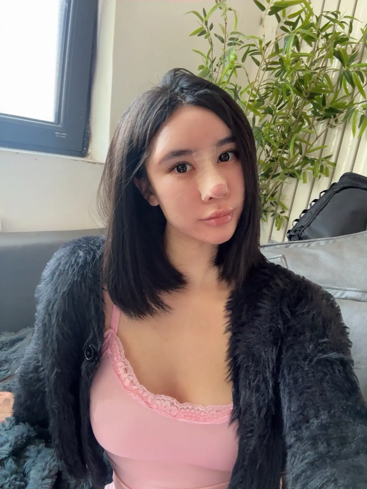 漫长的消肿期。