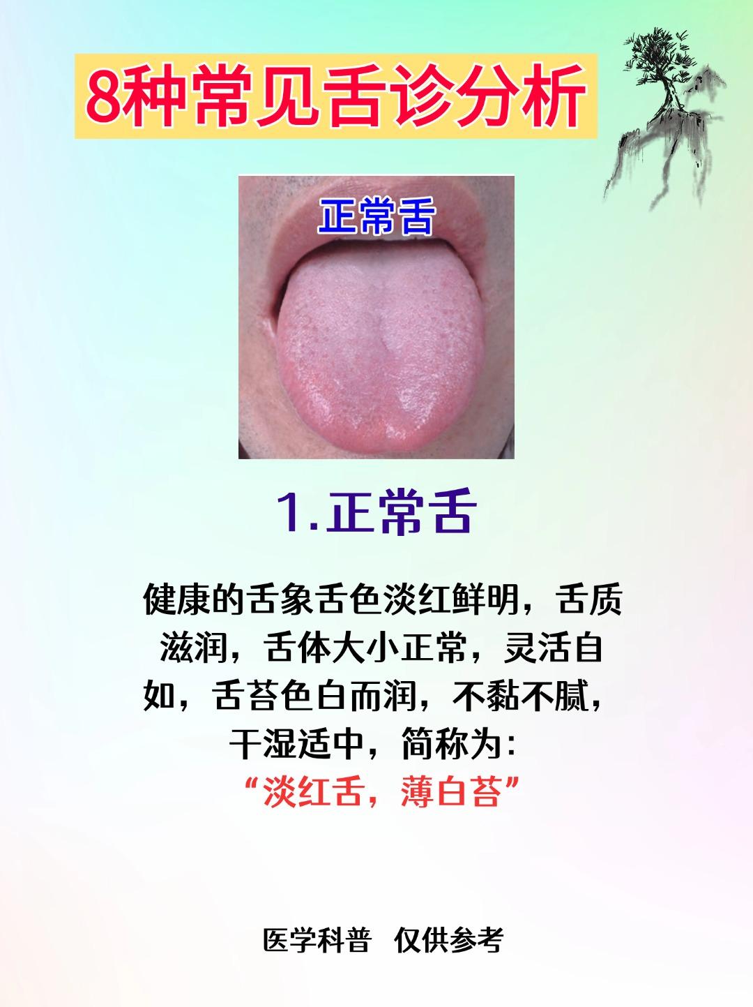 整理分享8种常见舌象分析，对照看看，你是属于哪一种情况？

1.正常舌——淡红舌