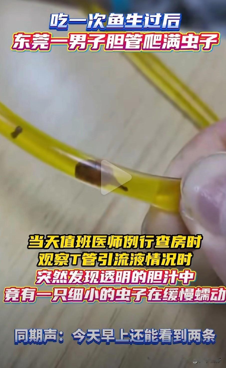 东莞一名40岁的厨师刘先生因频繁腹痛就医，手术后在胆汁引流管中发现多条正在蠕动的