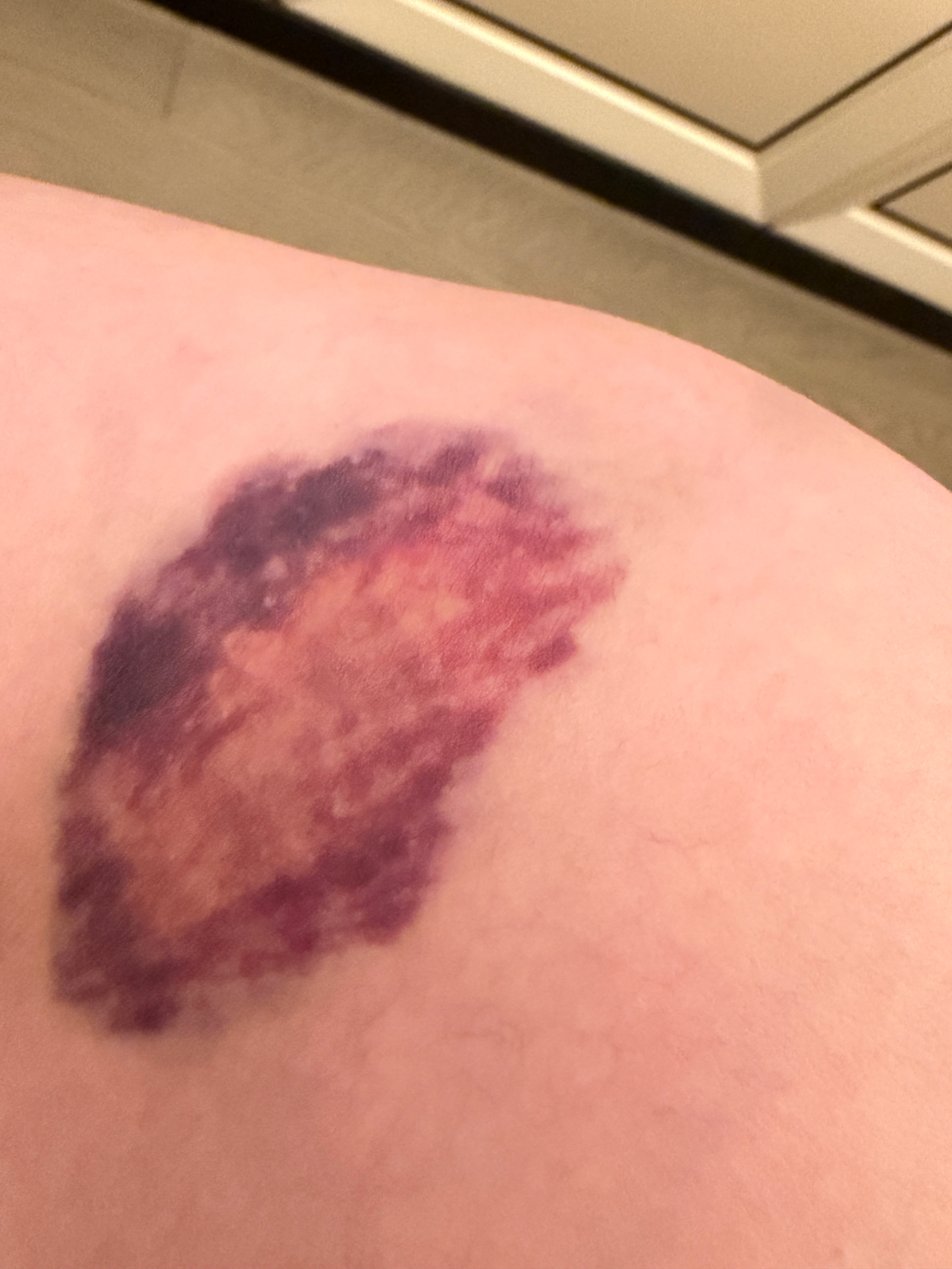 前两天没注意，把腿磕紫了，大概拳头大小的一块地方，所以今天来广州就没带裙子，想着