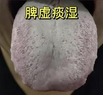 脾虚痰湿的舌象、症状和方剂对应太精准了！全舌厚腻苔 + 舌体胖大带齿痕，搭配身体