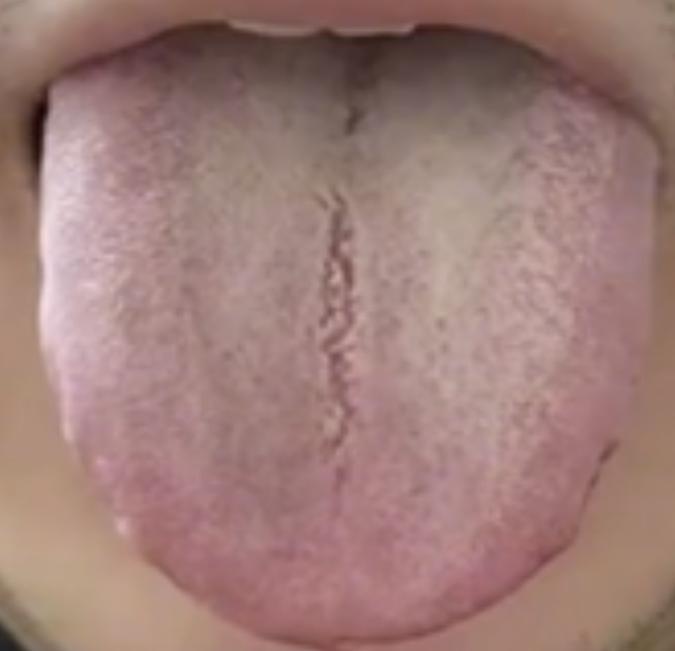 舌中裂纹，舌苔厚腻，别去健脾化痰，不然到头来竹篮打水一场空！

患者主诉：食欲很
