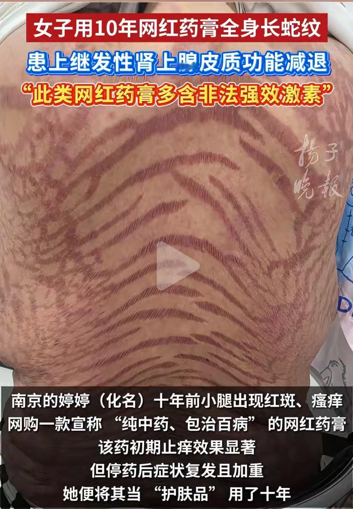 别再把“药膏”当护肤品！网红神药变毒药

在你为夏天湿疹烦恼，看到“三天见效”、