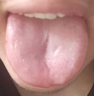 调理腰椎间盘突出，核心重在化解瘀血





对于腰间盘突出很多人并不陌生，每个
