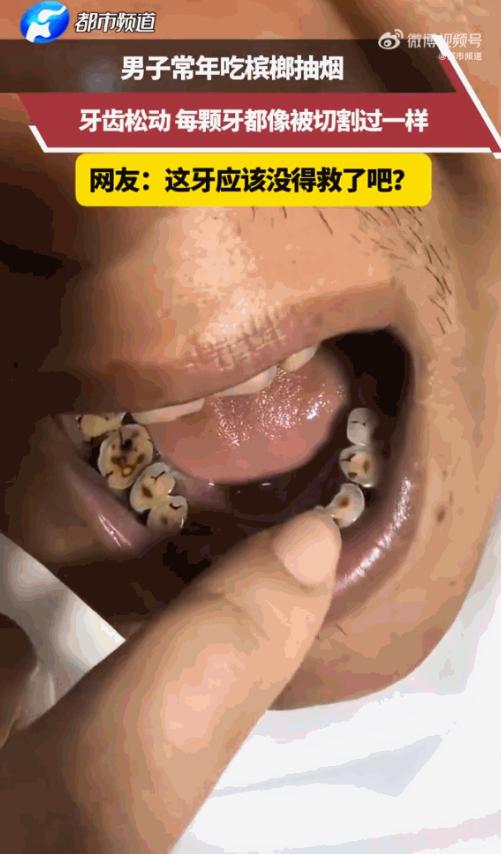 “触目惊心！”湖南，一名男子常年嚼槟榔、抽烟，结果一张嘴，满口黑牙跟被“切割”过