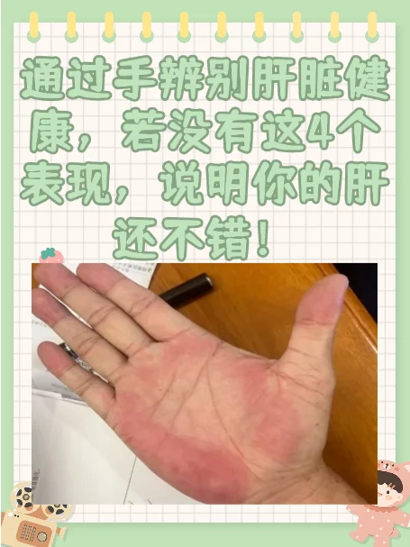 手辨别肝脏健康，没有这4个表现，肝还不错