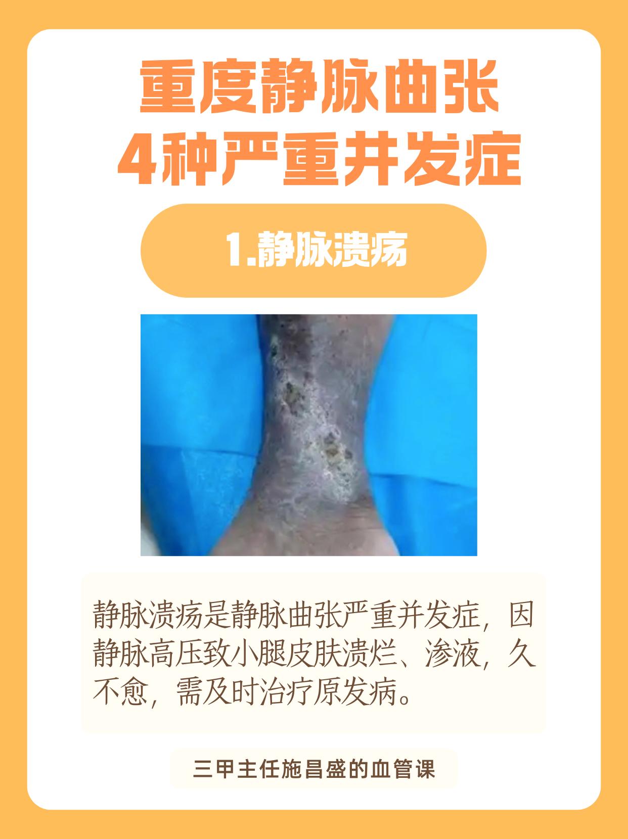 重度静脉曲张4种严重井发症。静脉溃疡致小腿溃烂久不愈；血栓脱落引发肺栓...