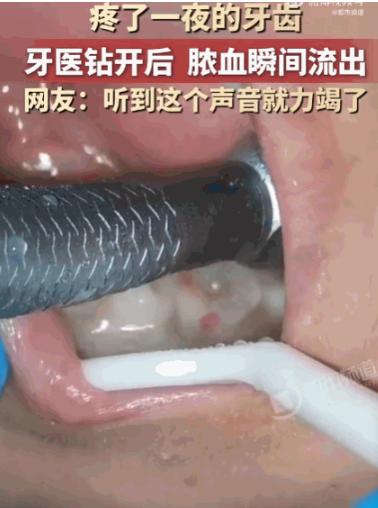看着都疼！河南，一男子深夜突发剧烈牙痛，整整一夜被折磨得死去活来，崩溃至极。次日