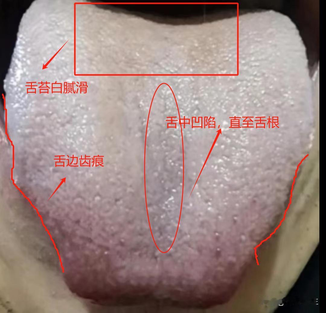 寒湿不除，阳气难补，白花花的舌头你吃金匮肾气芄去补肾阳真的没用，寒湿已经把脉络都