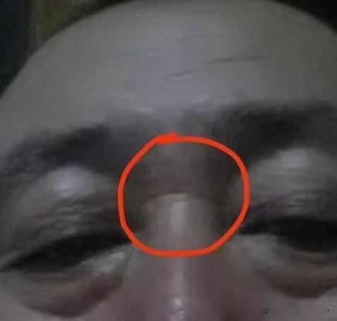 大家看这一位男士两眼内角之间有一条横纹，这个人四十来岁就打了一个支架，有一次在家
