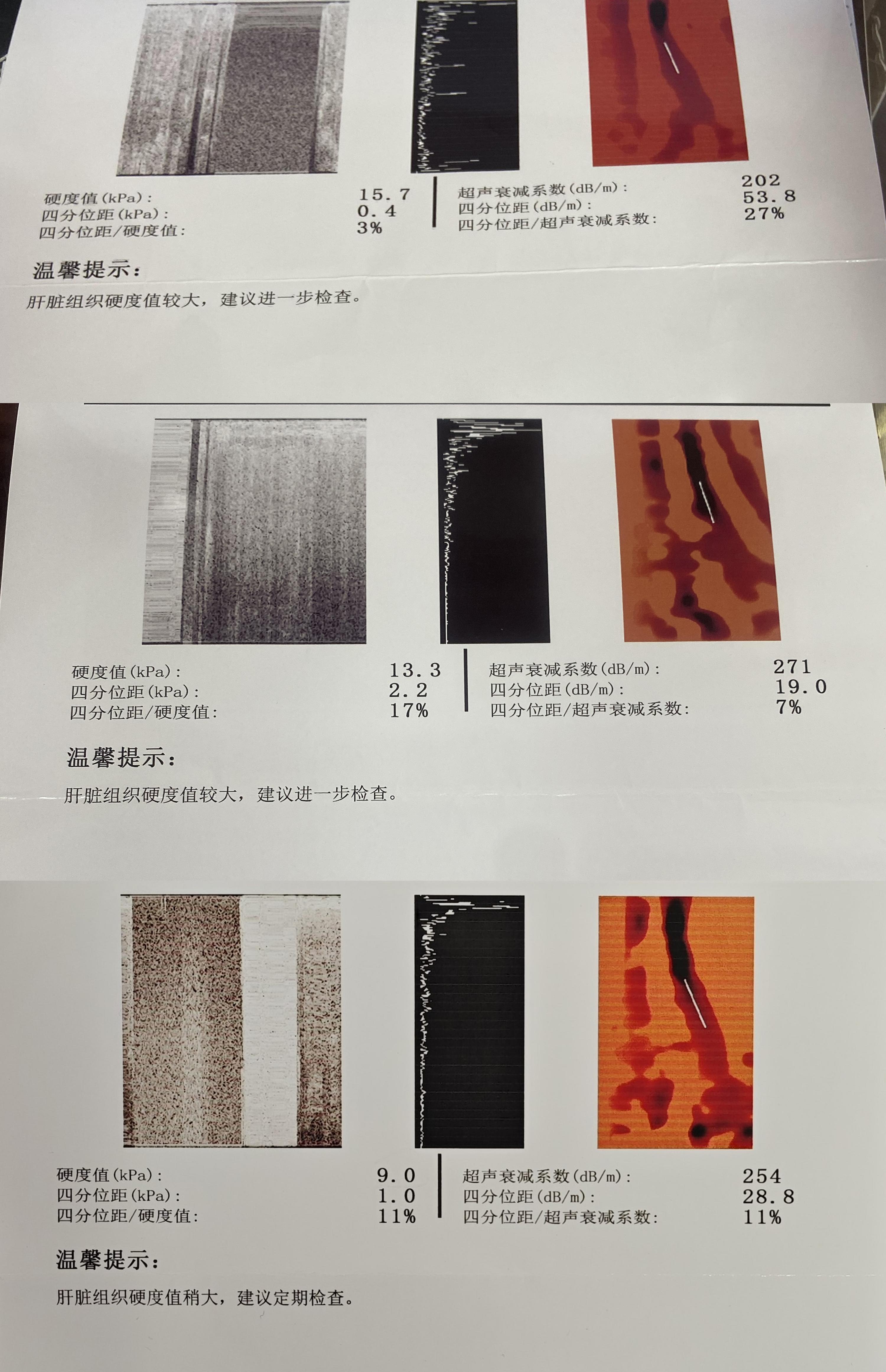 早期肝硬化患者，经过治疗，成功逆转，把这个好消息分享给大家，希望你们一...