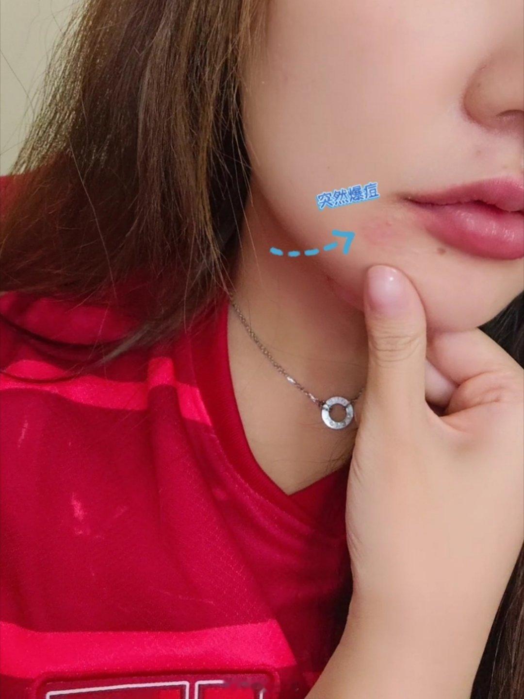 解说完浙江队3比3成都蓉城 后，发现嘴角凸起一个硬邦邦的痘[微笑]我真该喝点丝瓜