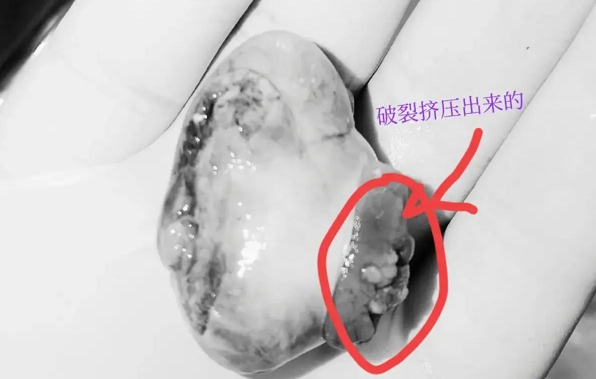 没事千万别“跨栏”，这个掉出来了…17岁小伙跳马路护栏没跳过去，然后这个掉出来了