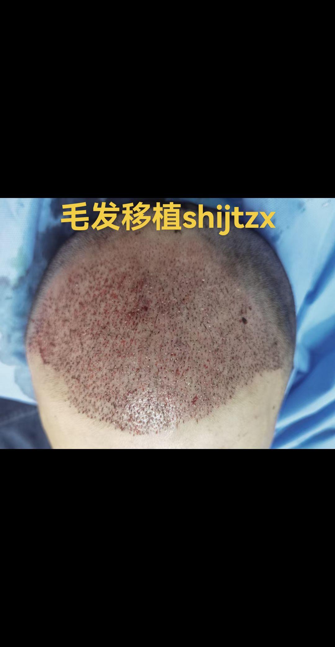 毛发移植。