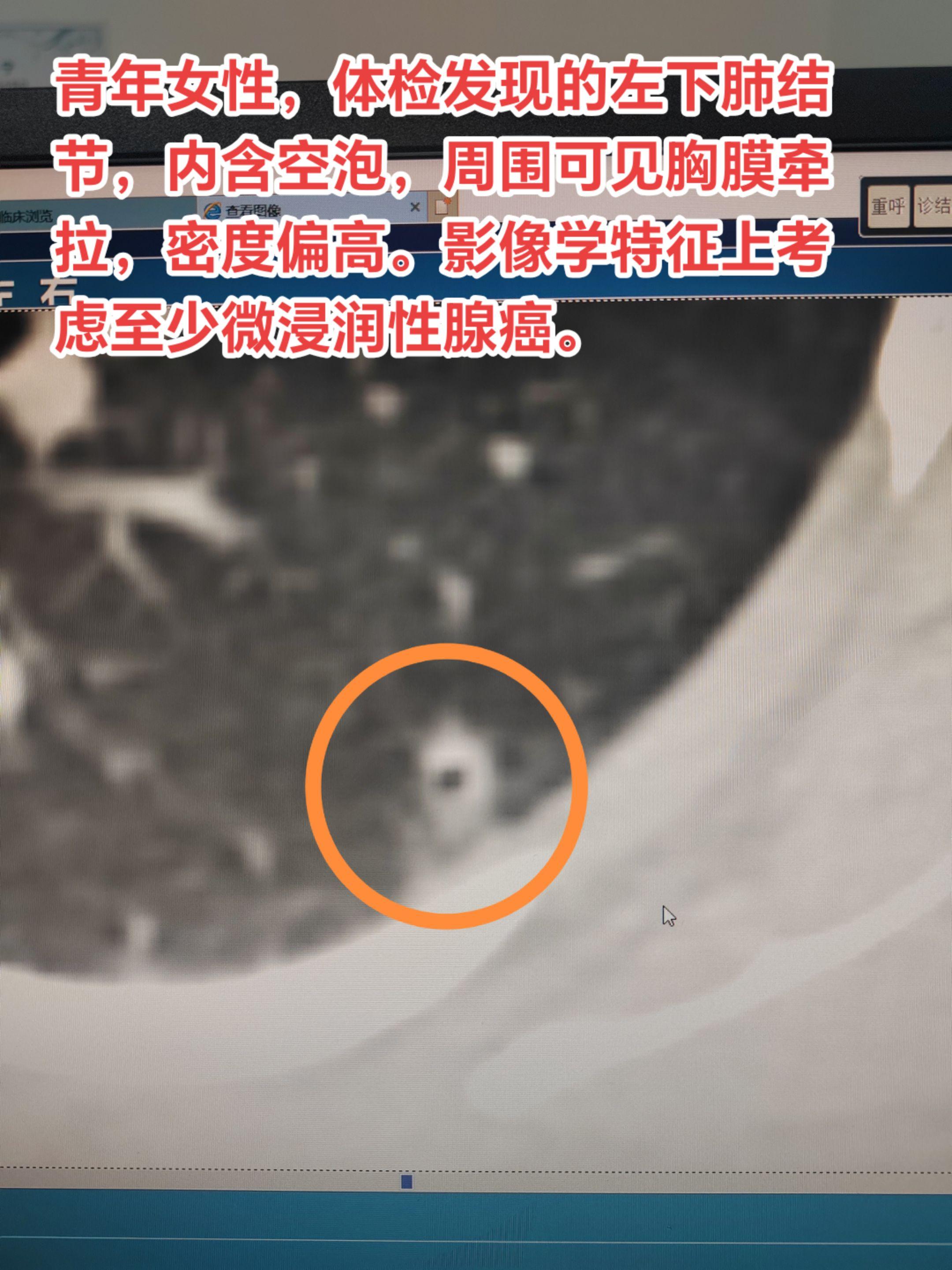肺结节含有空泡、胸膜牵拉需要高度警惕。青年女性，体检发现的左下肺结节...