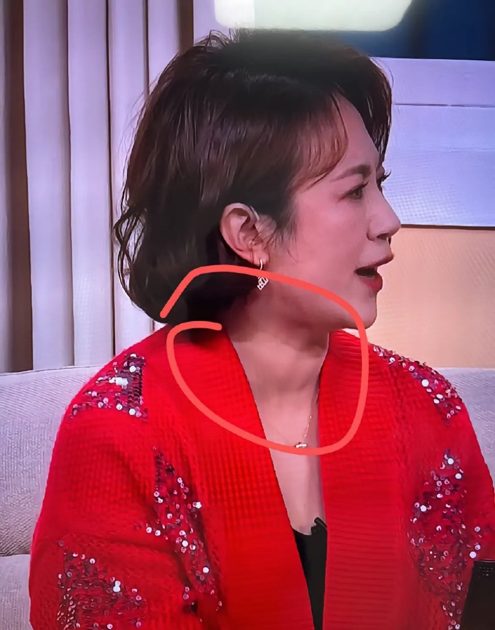 马丽 甲状腺 最近，网友们注意到马丽的脖子上似乎有一块肿胀的地方，怀疑她的甲状腺