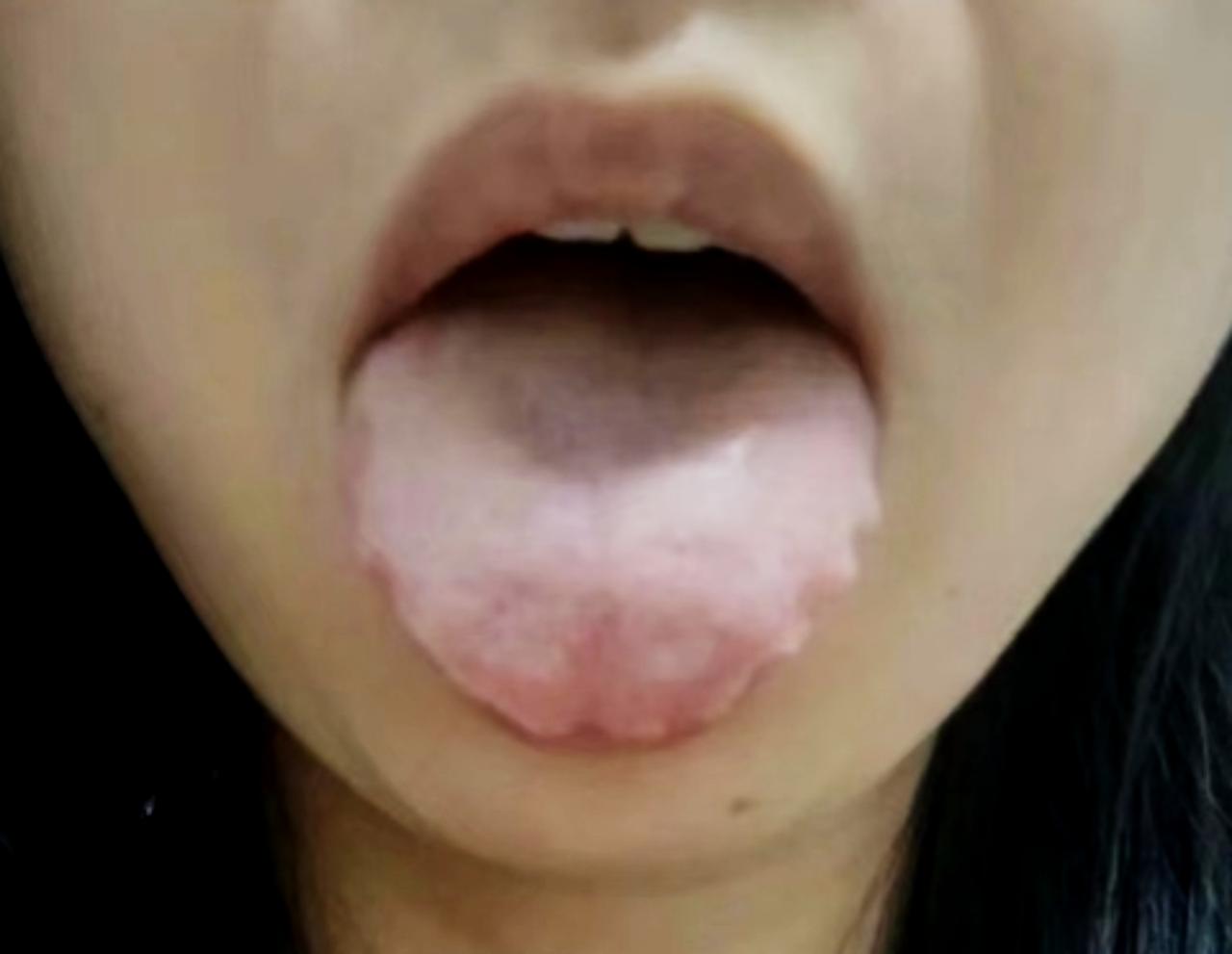 看似一圈齿痕印，如果你光顾着，祛湿健脾，麻烦就大了！

她可不是简单的舌头，更严