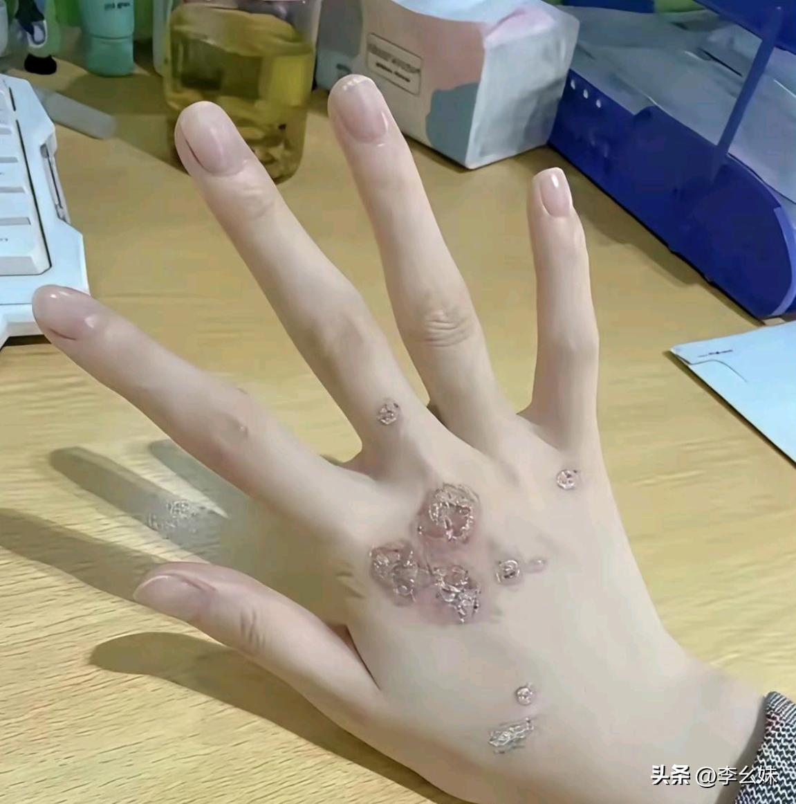 手上长的这是啥呀，该挂皮肤科吗？