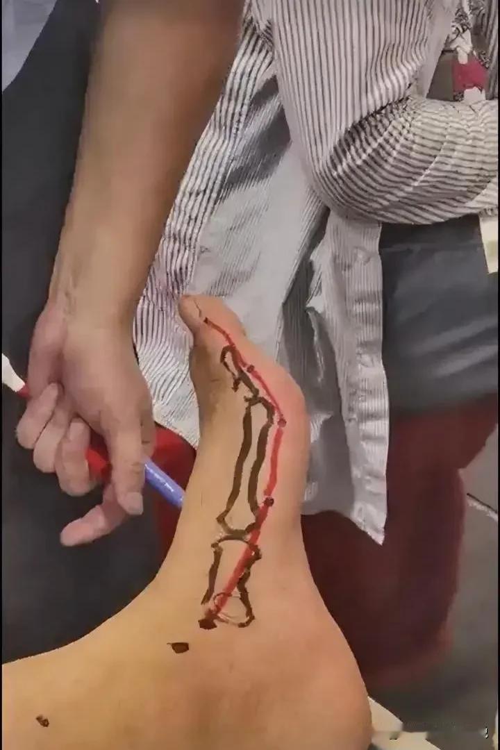 几种常见问题的组合针法，调理身体寒湿必用：
排寒组合针
1.双侧合谷直刺；
2.