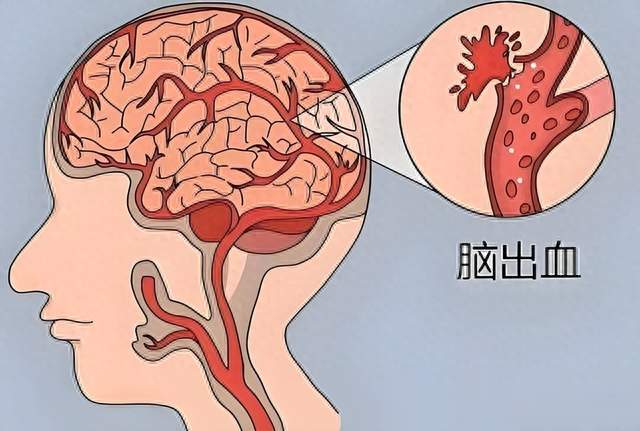 国内将逐渐停止“脑出血手术”？做完人就废了？医生讲出实情