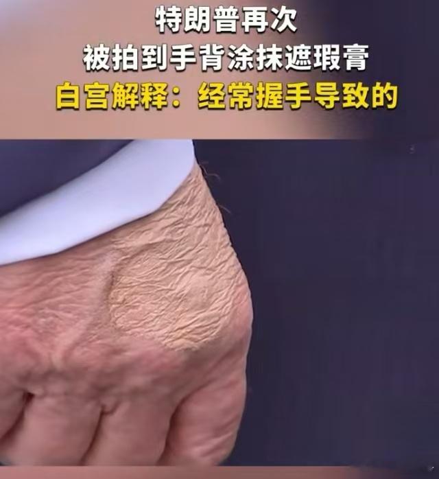 特朗普再被拍到用遮瑕膏遮手背瘀伤如此高龄活跃在政坛，不会像拜登一样时不时的摔倒所