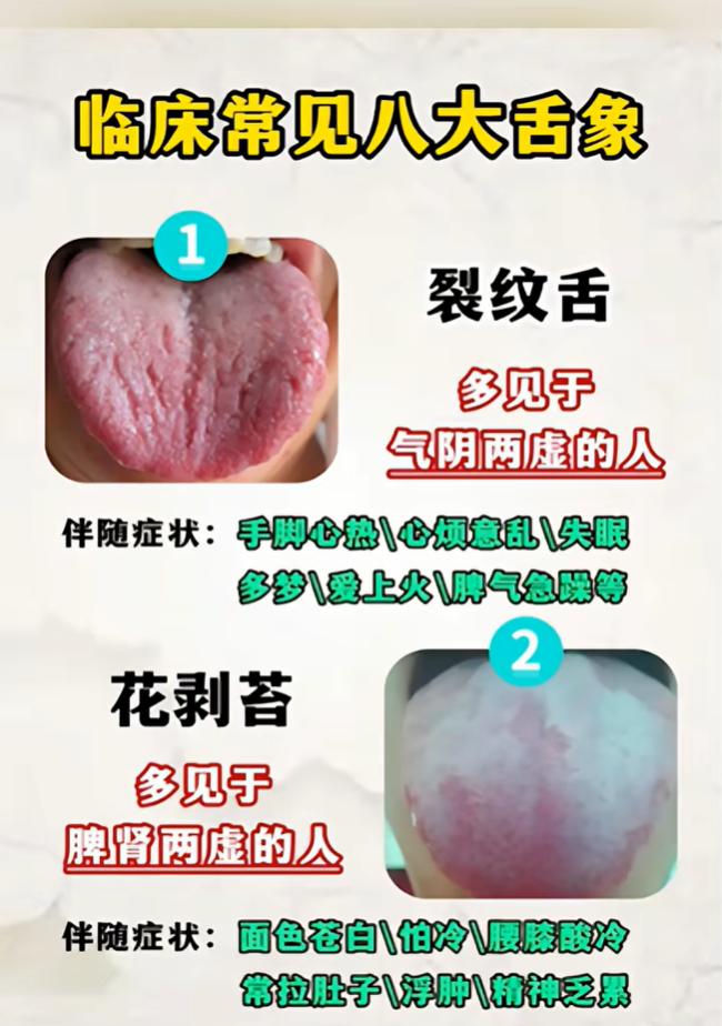 八种常见舌象自查！伸出舌头看看你属于哪一种