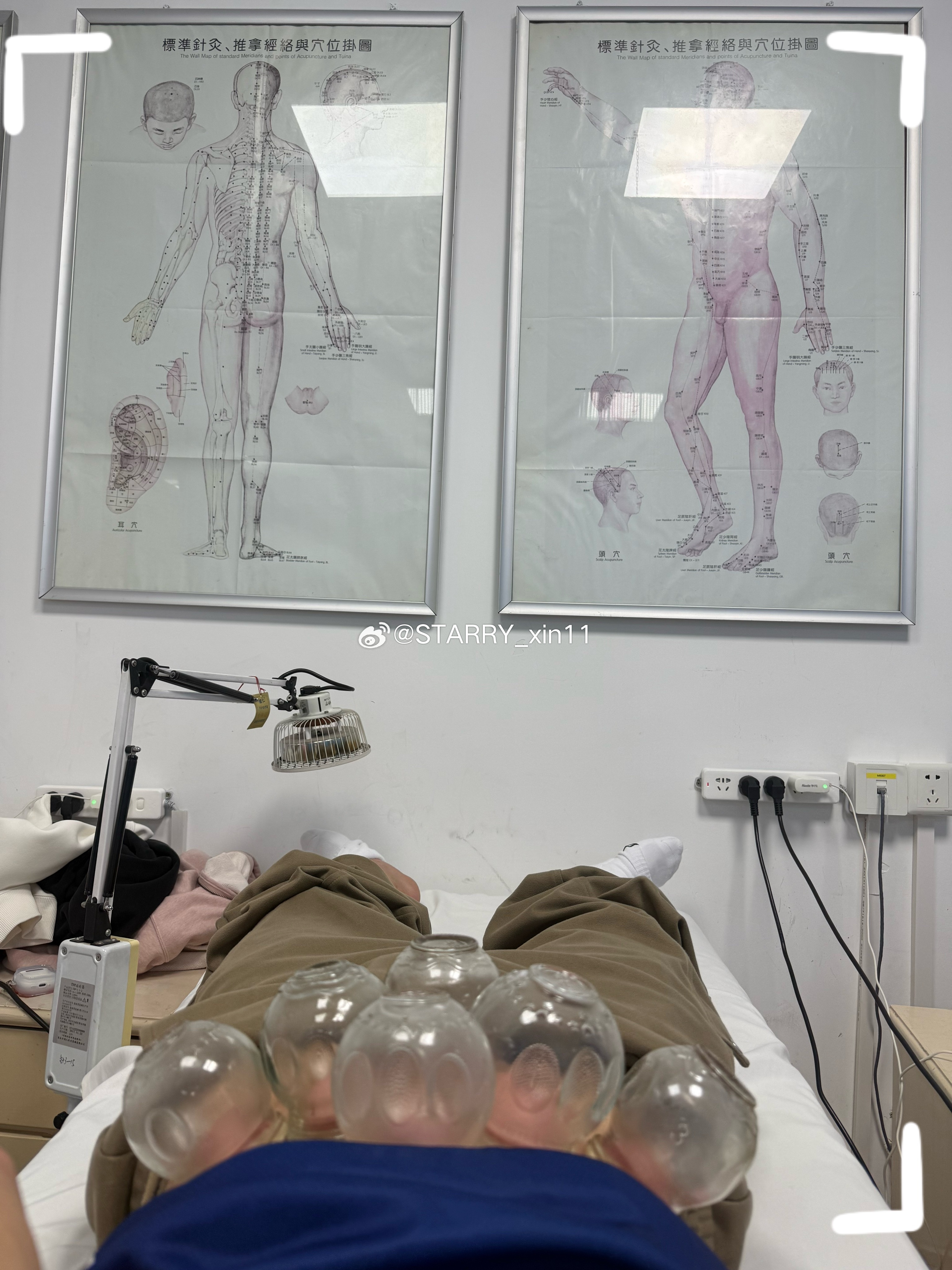 身子虚没力气看看做下针灸和拔罐会不会好点