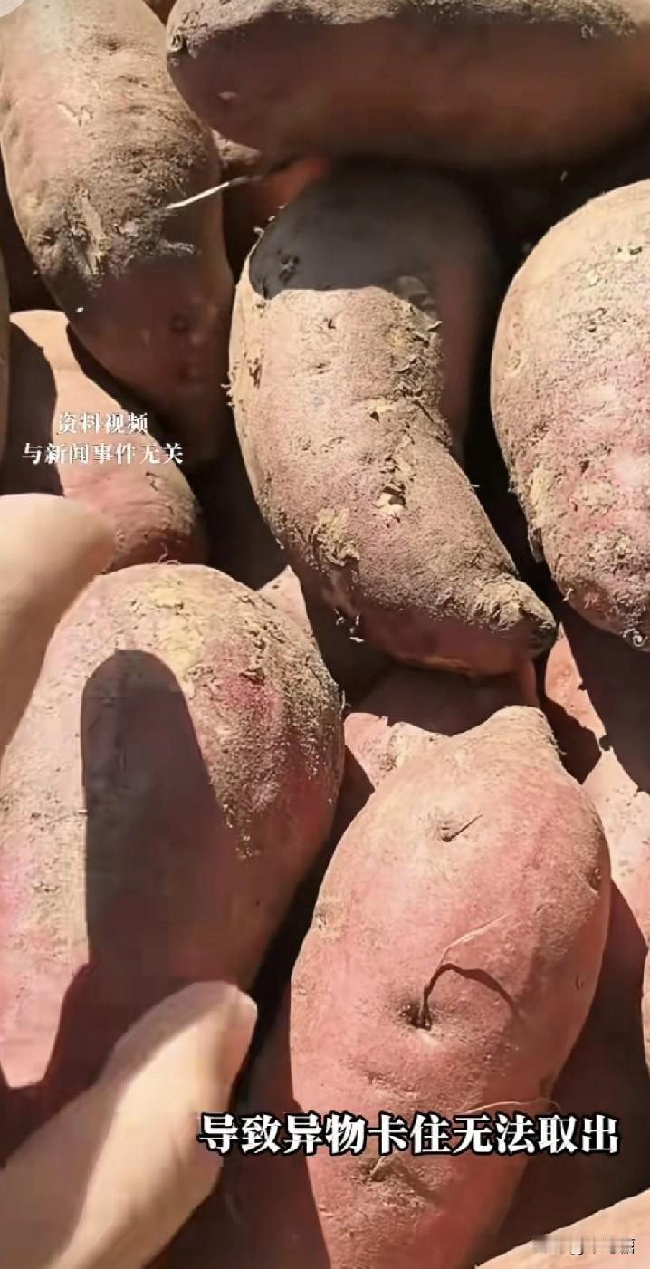 成都一大爷把17厘米红薯误入直肠，半夜疼到急诊，这是成都最近的一则肛肠科急诊案例