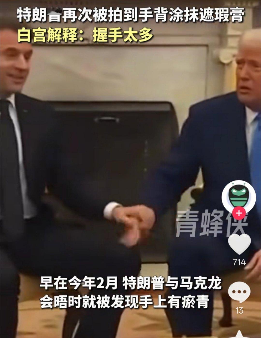 特朗普左手戴手套他这手2025年2月就发现有淤青了，现在都没好，还要戴手套来遮掩