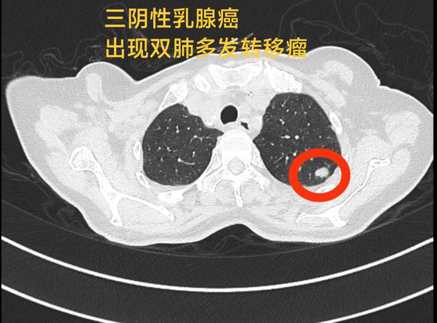 乳腺癌肺转移病例CT.