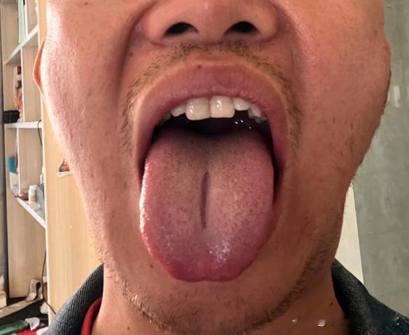门诊患者 ，刚36，就不行了，又是疲软，又是时间短
伸舌头一看，好家伙，你这身体