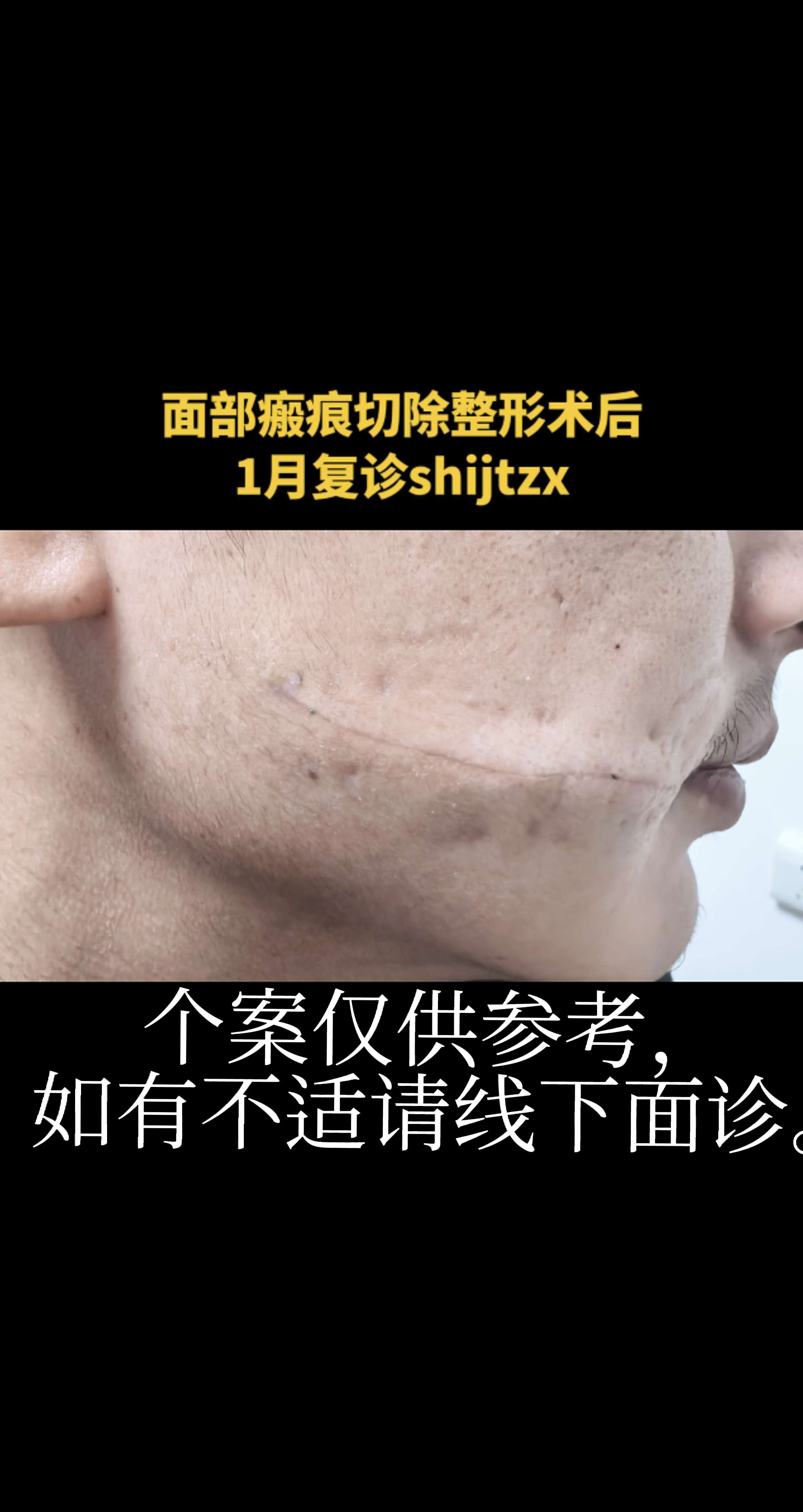 面部瘢痕。面部瘢痕切除整形术，超减张缝合术后，抹抗疤药，贴减张贴，穿戴...