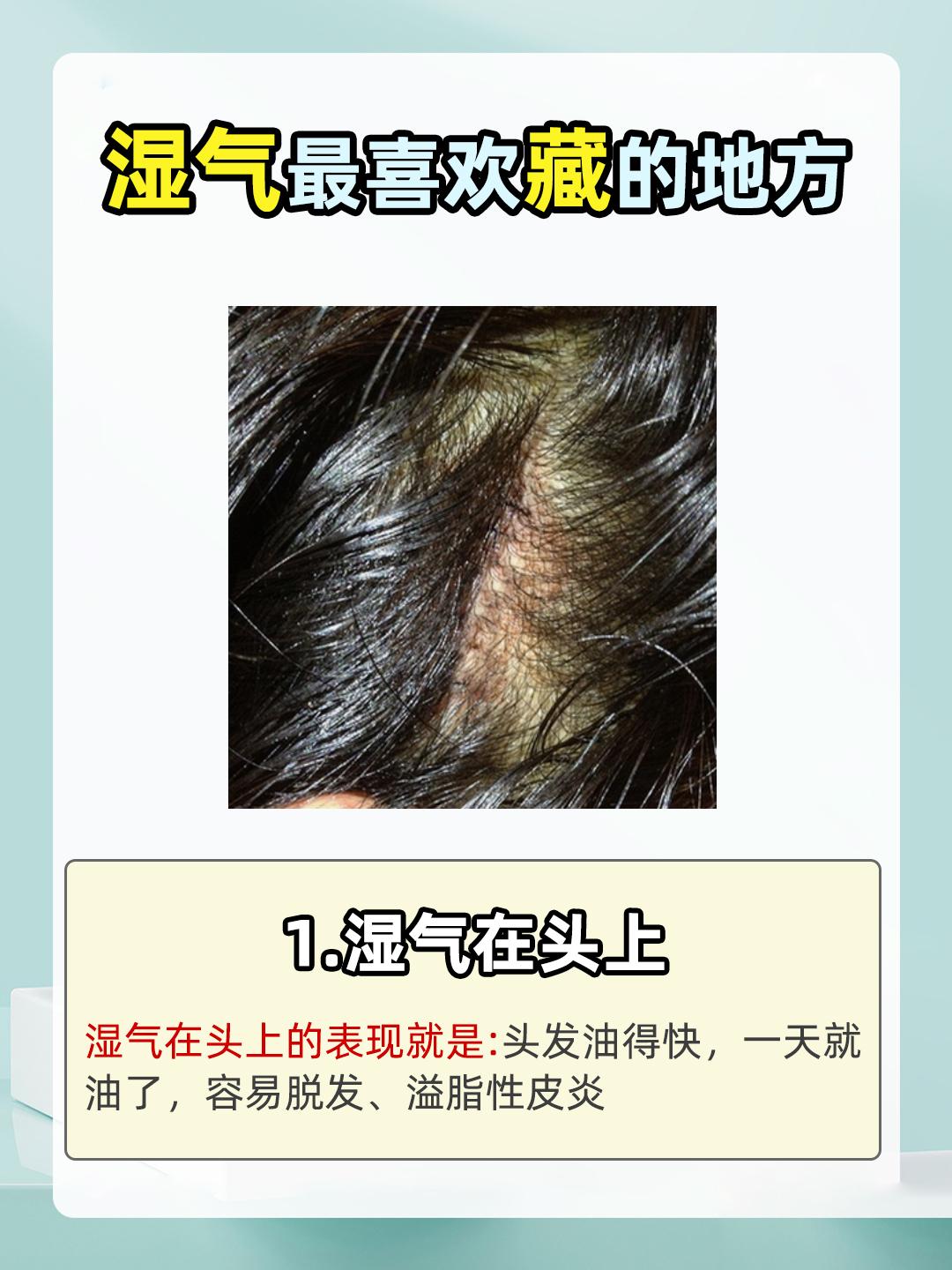 你身体的这4个地方藏有湿气吗？