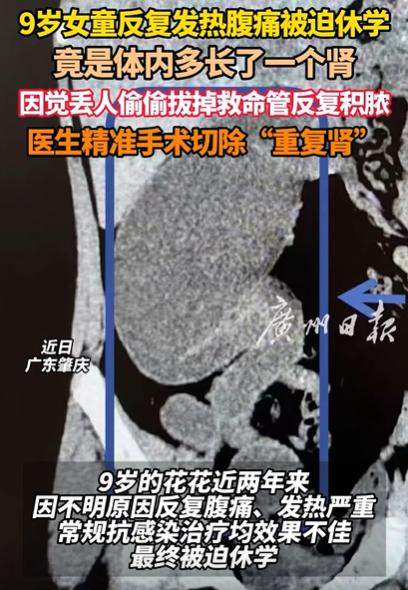 “解释不清了！” 广东，9 岁女孩反复发热腹痛，被迫休学！去医院检查，竟然发现女