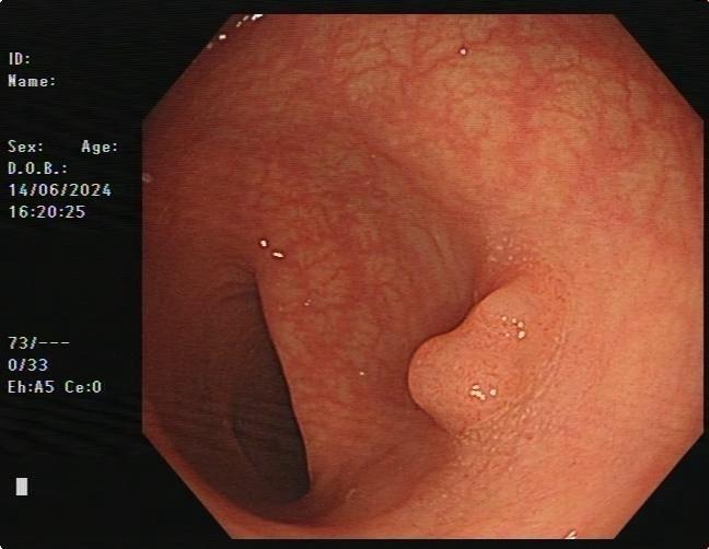 小小的结肠Cancer 一枚。女，61岁，体检，乙状结肠，0.8cm...
