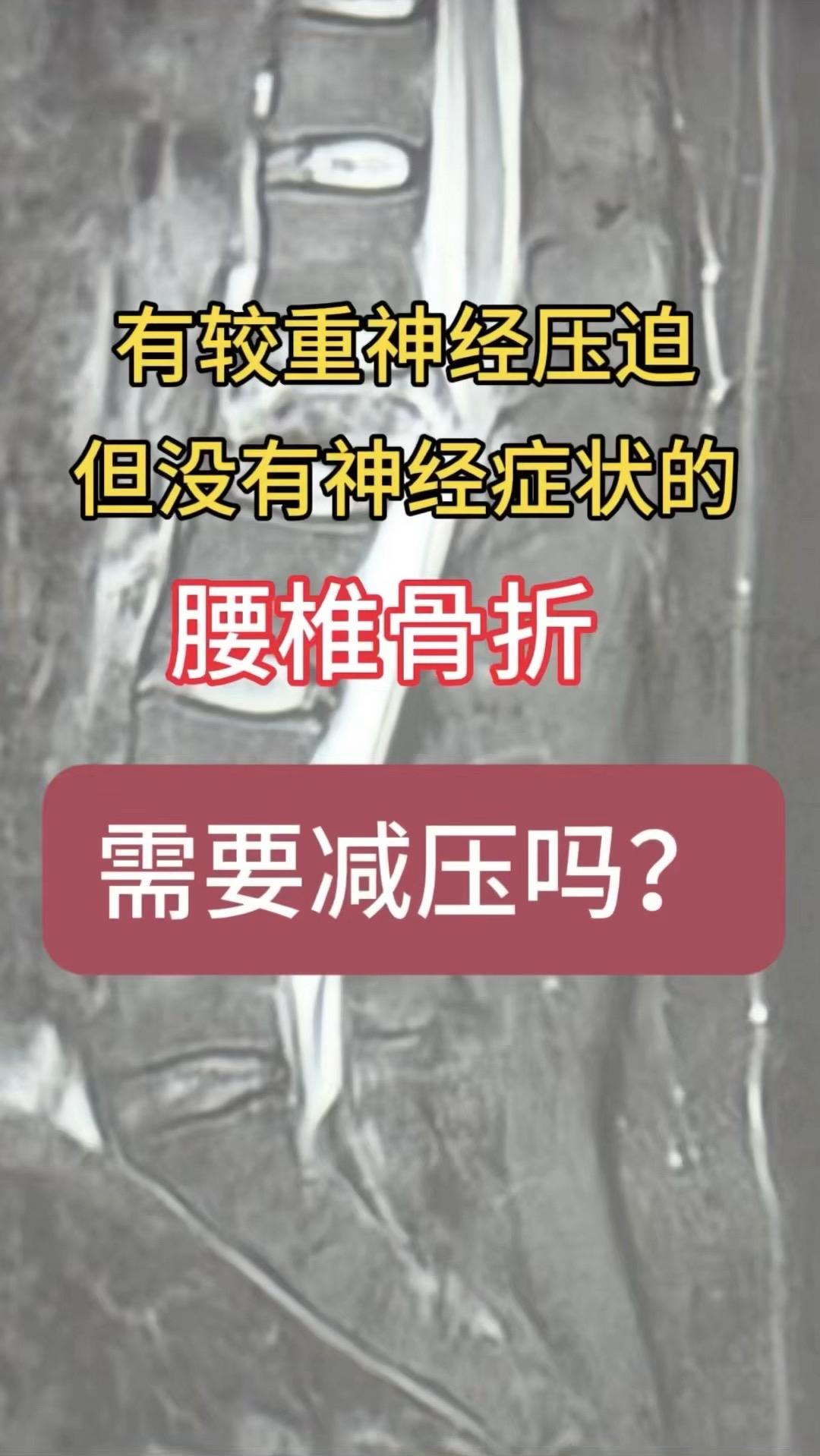 有较重神经压迫但没有神经症状的腰椎骨折需要减压吗？ 33岁女性，高处坠...