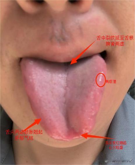 你看你这两边翘的像眼镜蛇一样，吓人一跳[打脸][打脸]
患者主诉：最近睡眠不好，