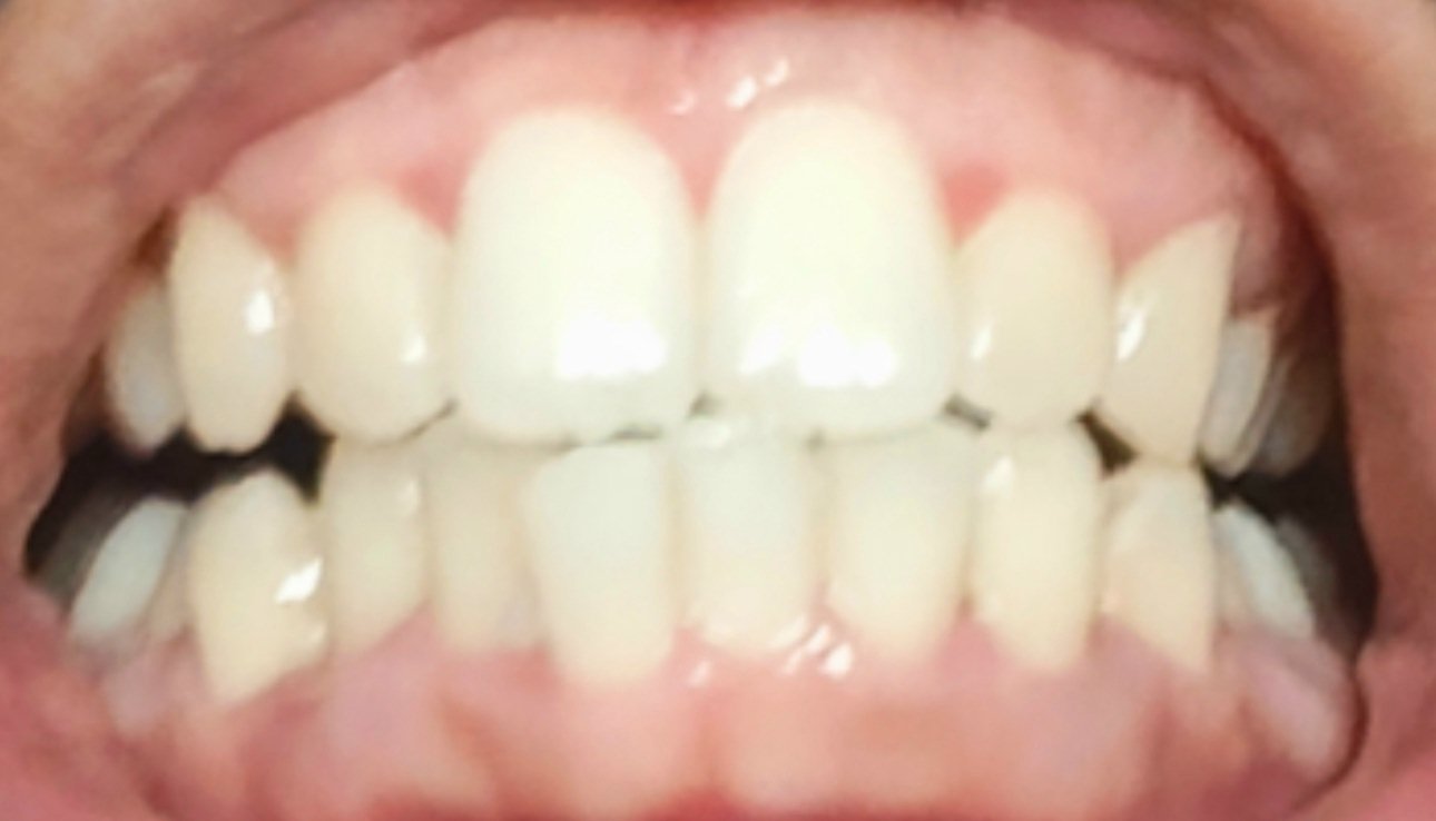 测试一款吹的很高的网红牙膏。不能说没用，但肯定没有吹的那么好分别试了一周，到3个