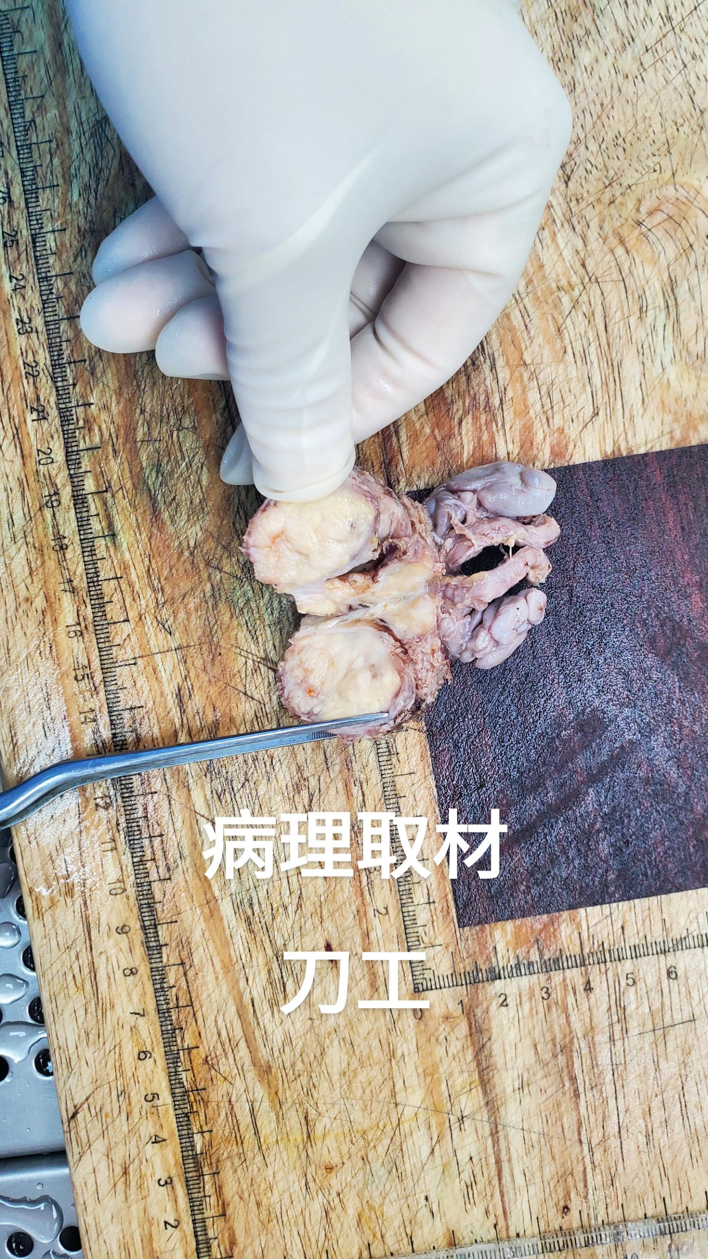 前列腺癌根治