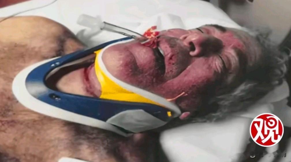 最新消息！爱泼斯坦“自缢”后照片首次公开：面部红肿可怖，甲状软骨近乎完全骨折。